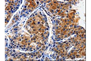 The image on the left is immunohistochemistry of paraffin-embedded Human liver cancer tissue using ABIN7128952(CLCA4 Antibody) at dilution 1/10, on the right is treated with fusion protein. (CLCA4 抗体)