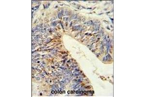 Formalin-fixed and paraffin-embedded human colon carcinoma reacted with ADDEC1 Antibody (N-term), which was peroxidase-conjugated to the secondary antibody, followed by DAB staining. (ADAMDEC1 抗体  (N-Term))