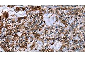 Immunohistochemistry of paraffin-embedded Human liver cancer using IMPDH2 Polyclonal Antibody at dilution of 1:60 (IMPDH2 抗体)