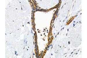 Phospho-Cytokeratin 18 (Ser51) Antibody at 1/100 staining Human liver cancer by IHC-P.