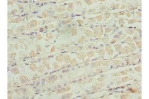 Immunohistochemistry of paraffin-embedded human gastric cancer using ABIN7176235 at dilution of 1:100 (ZNF324 抗体  (AA 1-270))