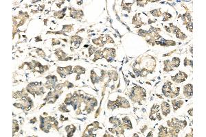 ABIN6261558 and ABIN6268802 at 1/100 staining Human pancreatic cancer by IHC-P.