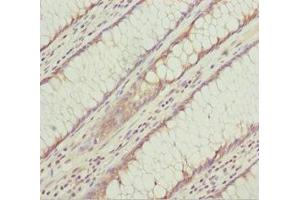 Immunohistochemistry of paraffin-embedded human colon cancer using ABIN7157310 at dilution of 1:100 (KLHL7 抗体  (AA 427-586))