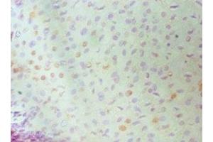 Immunohistochemistry of paraffin-embedded human cervical cancer using ABIN7150339 at dilution of 1:100 (MCM6 抗体  (AA 562-821))