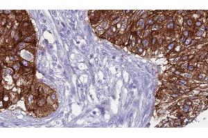 ABIN6276569 at 1/100 staining Human urothelial cancer tissue by IHC-P. (SMPD2 抗体  (Internal Region))