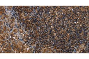 Immunohistochemistry of paraffin-embedded Human thyroid cancer tissue using HOMER2 Polyclonal Antibody at dilution 1:40 (HOMER2 抗体)