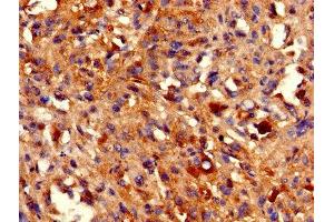 IHC image of ABIN7155391 diluted at 1:800 and staining in paraffin-embedded human melanoma performed on a Leica BondTM system. (HIST1H2BB 抗体  (AA 2-126))