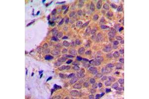 Immunohistochemical analysis of RPL7 staining in human prostate cancer formalin fixed paraffin embedded tissue section. (RPL7 抗体  (C-Term))