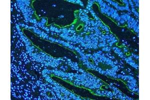 IF analysis of Villi using anti-Villi antibody (ABIN3042343) Villi was detected in paraffin-embedded section of human rectal cancer tissues.