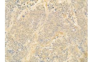 ABIN6262538 and ABIN6278893 at 1/100 staining human small cell lung carcinoma by IHC-P. (IL17B 抗体  (Internal Region))