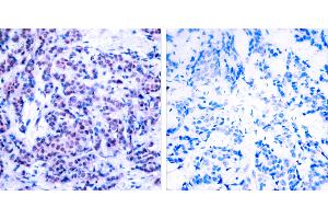 P-Peptide - +Immunohistochemical analysis of paraffin-embedded human breast carcinoma tissue using JunD (phospho- Ser255) antibody. (JunD 抗体  (pSer255))