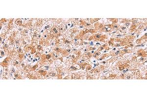 Immunohistochemistry of paraffin-embedded Human liver cancer tissue using IL4R Polyclonal Antibody at dilution of 1:45(x200) (IL4 Receptor 抗体)