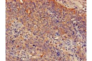 Immunohistochemistry of paraffin-embedded human cervical cancer using ABIN7148581 at dilution of 1:100 (SPRR1A 抗体  (AA 8-72))