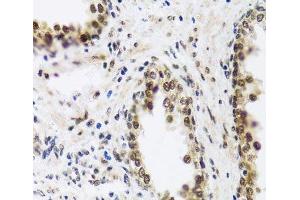Immunohistochemistry of paraffin-embedded Human prostate using SAFB2 Polyclonal Antibody at dilution of 1:100 (40x lens). (SAFB2 抗体)