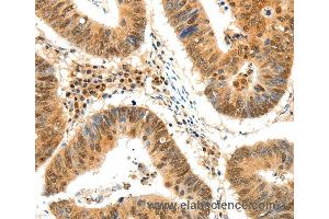 Immunohistochemistry of Human colon cancer using TERF2 Polyclonal Antibody at dilution of 1:50 (TRF2 抗体)
