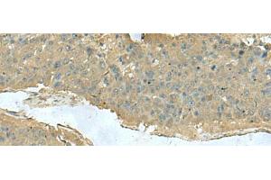 Immunohistochemistry of paraffin-embedded Human liver cancer tissue using KRT36 Polyclonal Antibody at dilution of 1:50(x200) (Keratin 36 抗体)