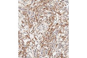 Immunohistochemical analysis of paraffin-embedded Human breast carcinoma tissue using B performed on the Leica® BOND RXm. (FGFR2 抗体  (C-Term))