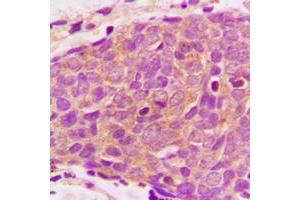 Immunohistochemical analysis of PRAS40 staining in human breast cancer formalin fixed paraffin embedded tissue section. (PRAS40 抗体  (C-Term))