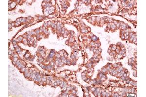 Formalin-fixed and paraffin embedded human lung carcinoma labeled with Anti-Ninjurin 1 Polyclonal Antibody, Unconjugated  at 1:500 followed by conjugation to the secondary antibody and DAB staining (NINJ1 抗体  (AA 1-80))