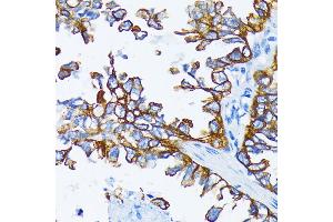 Immunohistochemistry of paraffin-embedded human lung cancer using Cytokeratin 7 (Cytokeratin 7 (KRT7)) antibody (ABIN6129292, ABIN6143037, ABIN6143039 and ABIN6215559) at dilution of 1:200 (40x lens). (Cytokeratin 7 抗体  (AA 1-94))