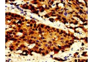Immunohistochemistry of paraffin-embedded human cervical cancer using ABIN7150346 at dilution of 1:100 (TOP2B 抗体  (AA 1400-1626))