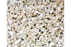 Anti-Selenium Binding Protein 1 antibody, IHC(P) IHC(P): Human Liver Cancer Tissue (SELENBP1 抗体  (Middle Region))