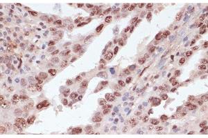 Immunohistochemistry of paraffin-embedded Human lung cancer using Phospho-ATF2(T71) Polyclonal Antibody at dilution of 1:100 (40x lens). (ATF2 抗体  (pThr71))