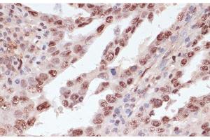 Immunohistochemistry of paraffin-embedded Human lung cancer using Phospho-ATF2(T71) Polyclonal Antibody at dilution of 1:100 (40x lens).