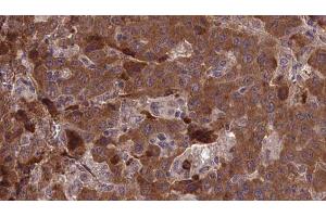 ABIN6277362 at 1/100 staining Human liver cancer tissue by IHC-P. (EDNRB 抗体  (C-Term))