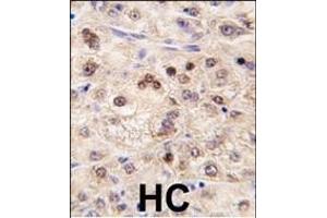 Formalin-fixed and paraffin-embedded human hepatocarcinoma tissue reacted with ZBTB7B antibody (Center) (ABIN390349 and ABIN2840763) , which was peroxidase-conjugated to the secondary antibody, followed by DAB staining. (ZBTB7B 抗体  (AA 181-210))