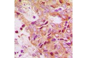 Immunohistochemical analysis of RPS13 staining in human breast cancer formalin fixed paraffin embedded tissue section. (RPS13 抗体)