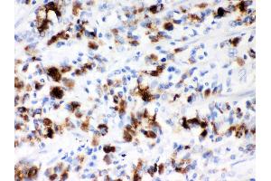Anti- Mucin-5AC Picoband antibody, IHC(P) IHC(P): Human Gastric Cancer Tissue (MUC5AC 抗体  (AA 4848-5030))