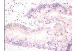 Immunohistochemistry of paraffin-embedded human colon cancer using ABIN7155377 at dilution of 1:100 (H2AFJ 抗体  (AA 2-129))