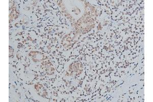 ABIN6267039 at 1/200 staining human breast cancer tissue sections by IHC-P. (Histone 3 抗体)