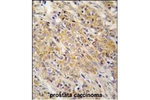 Forlin-fixed and paraffin-embedded hun prostata carcino tissue reacted with P2K2 Antibody  (ABIN1881526 and ABIN2842063) , which was peroxidase-conjugated to the secondary antibody, followed by DAB staining. (MEK2 抗体  (AA 200-229))