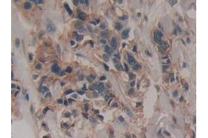 Detection of PPARa in Human Breast cancer Tissue using Polyclonal Antibody to Peroxisome Proliferator Activated Receptor Alpha (PPARa) (PPARA 抗体  (AA 61-170))