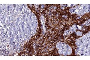 ABIN6279127 at 1/100 staining Human Head and neck cancer tissue by IHC-P. (SLC4A3 抗体  (N-Term))