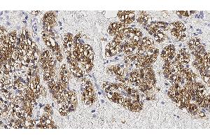 Human parathyroid adenoma: immunohistochemical staining for Parathyroid Hormone. (PTH 抗体)