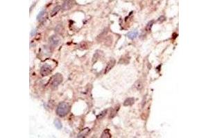 IHC analysis of FFPE human breast carcinoma tissue stained with the SUV39H2 antibody (SUV39H2 抗体  (AA 360-390))