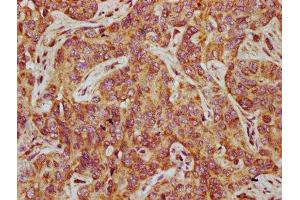 IHC image of ABIN7165837 diluted at 1:500 and staining in paraffin-embedded human liver cancer performed on a Leica BondTM system. (NTAN1 抗体  (AA 219-310))