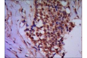 IHC of paraffin-embedded human breast cancer using anti-Protein Phosphatase 4C mouse mAb diluted 1/500-1/1000. (Protein Phosphatase 4C 抗体)