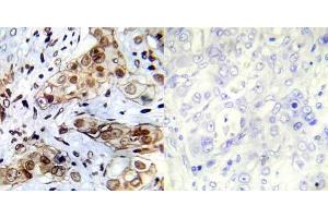 Immunohistochemical analysis of paraffin- embedded human breast carcinoma tissue using Abl1 (Ab-412) antibody (E022002). (ABL1 抗体)