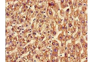 Immunohistochemistry of paraffin-embedded human liver cancer using ABIN7144713 at dilution of 1:100