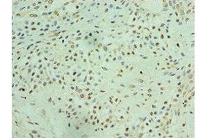 Immunohistochemistry of paraffin-embedded human breast cancer using ABIN7172050 at dilution of 1:100 (THOC1 抗体  (AA 428-657))