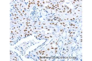 Immunohistochemistry of Human gastric cancer using ARID1A Polyclonal Antibody at dilution of 1:80 (ARID1A 抗体)