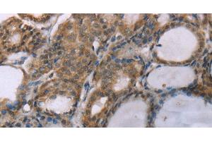 Immunohistochemistry of paraffin-embedded Human thyroid cancer using ACTN2 Polyclonal Antibody at dilution of 1:30 (ACTN2 抗体)