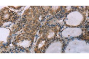 Immunohistochemistry of paraffin-embedded Human thyroid cancer using ACTN2 Polyclonal Antibody at dilution of 1:30 (ACTN2 抗体)
