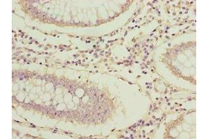 Immunohistochemistry of paraffin-embedded human colon cancer using ABIN7144631 at dilution of 1:100 (ARPIN 抗体  (AA 1-226))