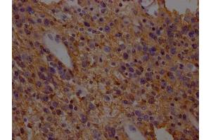 IHC image of ABIN7152226 diluted at 1:200 and staining in paraffin-embedded human glioma cancer performed on a Leica BondTM system. (SLC1A3 抗体  (AA 146-236))