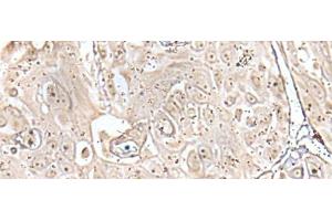 Immunohistochemistry of paraffin-embedded Human esophagus cancer tissue using VRK3 Polyclonal Antibody at dilution of 1:45(x200) (VRK3 抗体)